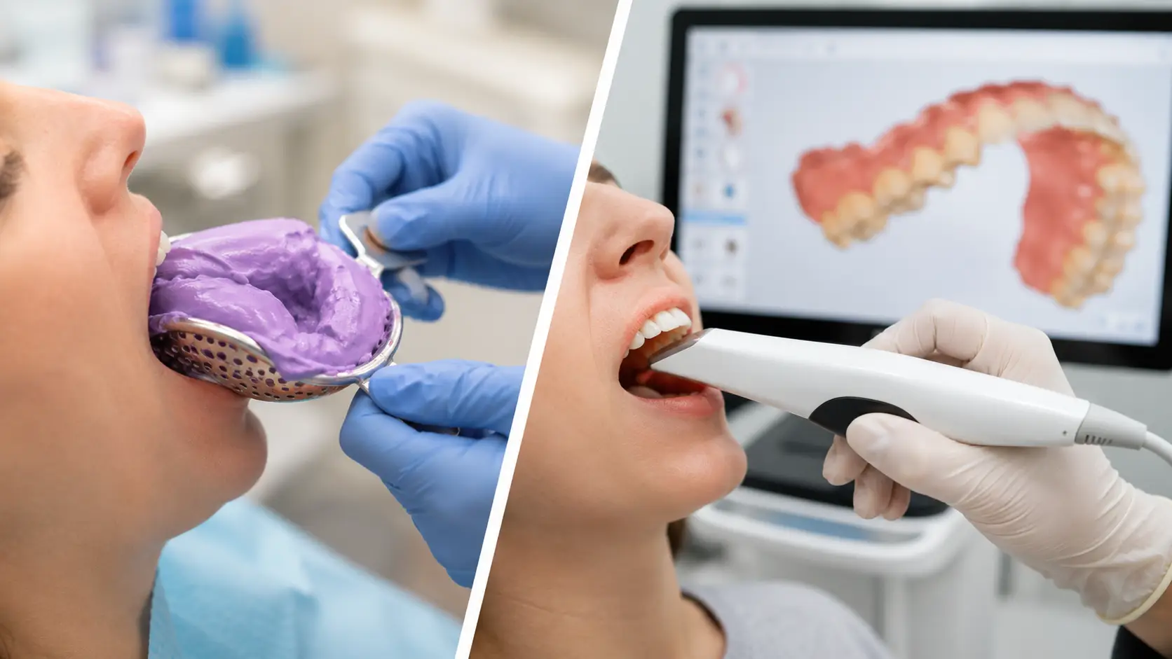 are-digital-dental-scans-better-than-traditional-impressions